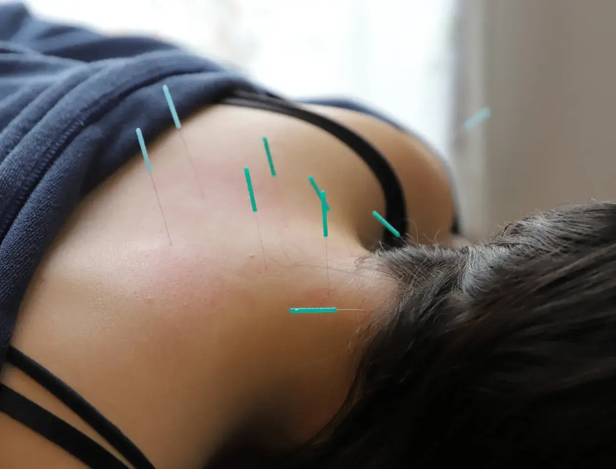 美容鍼